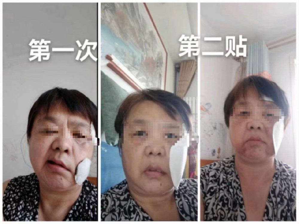 奇效面瘫王  一贴见效，恢复如初