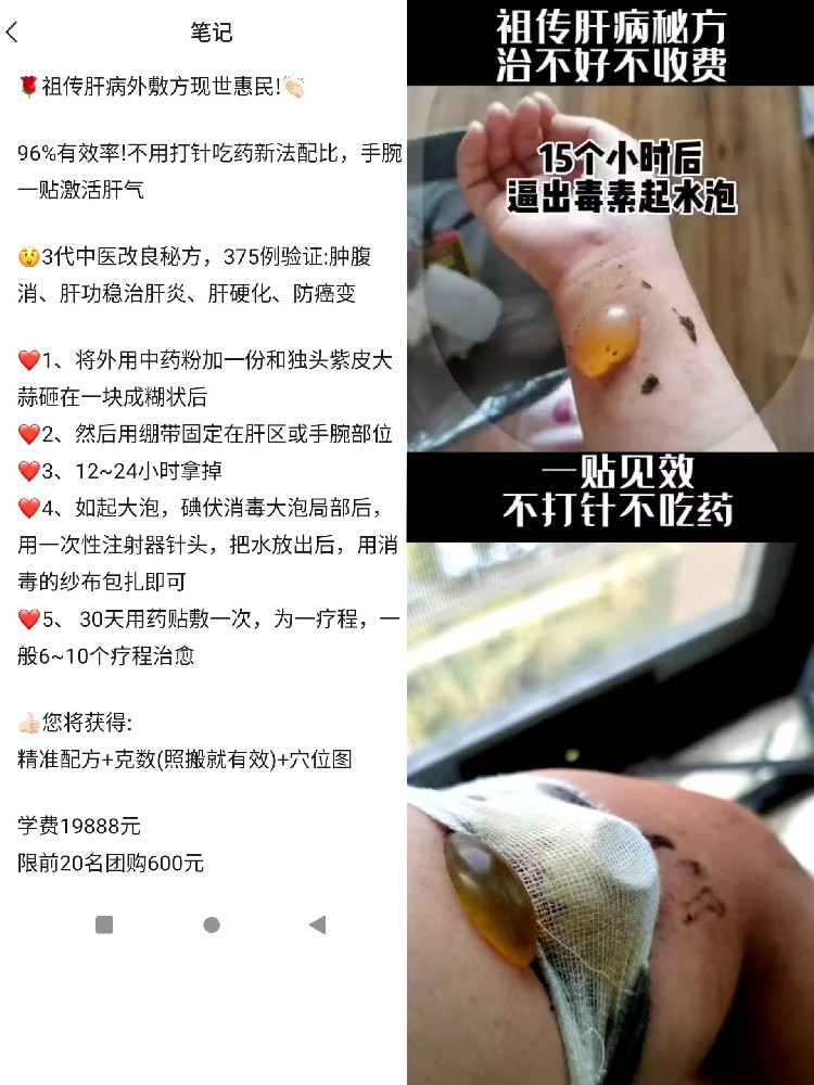 肝病肝硬化外敷神方